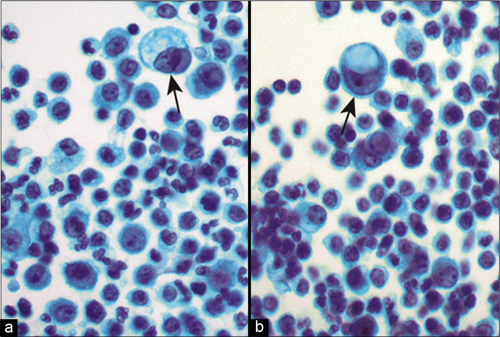 a,b Metastatic gastric adenocarcinoma. Isolated atypical cells are shown (arrows) admixed with inflammatory cells. Large cytoplasmic vacuoles resulting in a signet ring cell appearance are noted. (Cytospin preparation, Papanicolaou stain, 400X)