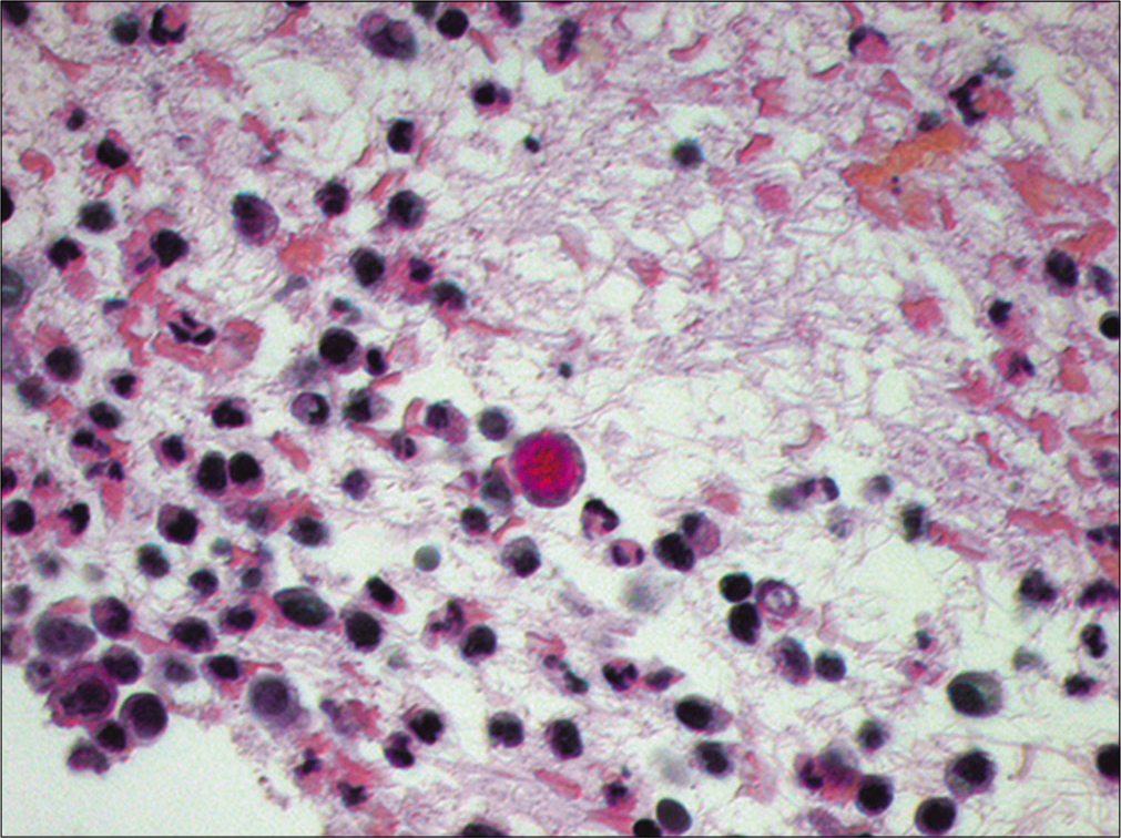 Metastatic gastric adenocarcinoma. A central tumor cell is shown stained red (positive) for intracytoplasmic mucin (Cell-block preparation, mucicarmine stain, 400X)