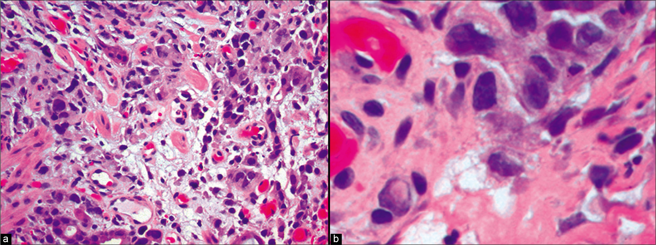 Metastatic gastric adenocarcinoma. a, Gastric biopsy showing infiltration by a poorly differentiated adenocarcinoma. b, Pleomorphic malignant cells are shown at higher power, some with a signet ring cell appearance. (Gastric biopsy, a, HE, 100×; b, 400X)