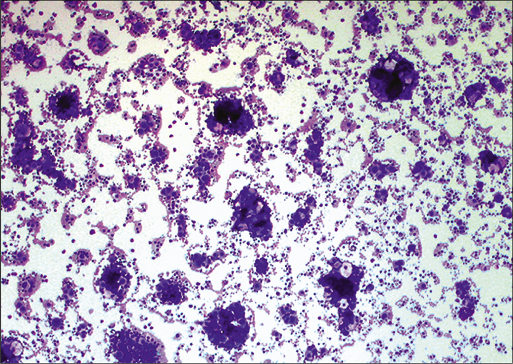 Metastatic ovarian carcinoma. Low power showing numerous 3-dimensional cell groups, resulting in a ‘cannonball’ appearance. (Cytospin preparation, modified Romanowsky stain, 100X)