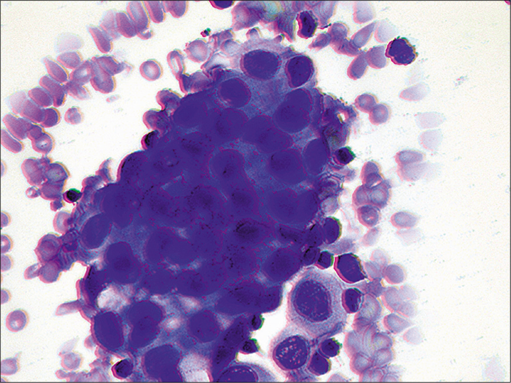 Metastatic ovarian carcinoma. A cohesive, 3-dimensional group of cells with large nuclei and increased nuclear/cytoplasmic ratio. (Cytospin preparation, modified Romanowsky stain, 400X)