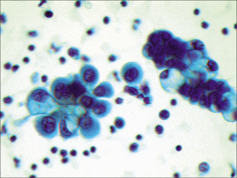 Metastatic ovarian carcinoma. Papillary groups of tumor cells with large neoplastic cells. Some cells have vacuolated cytoplasm, which is characteristic of ovarian carcinoma present in body fluids. (Cytospin preparation, Papanicolaou stain, 400X)