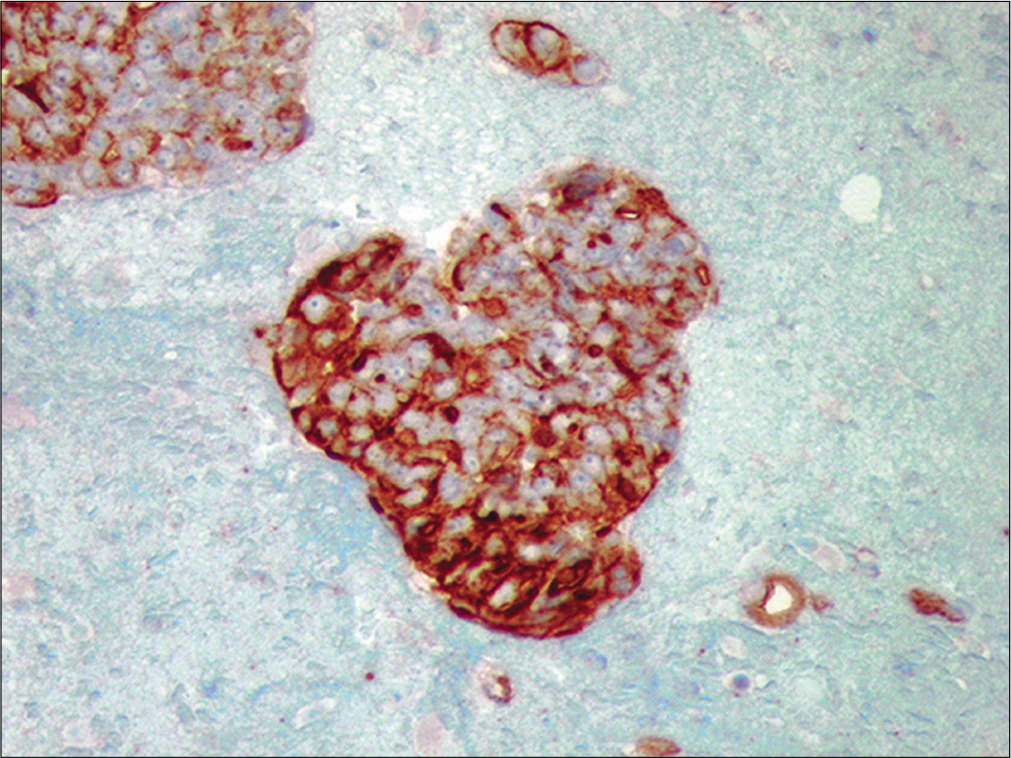 Metastatic ovarian carcinoma. The neoplastic cells are positive for CA-125, supporting their ovarian origin (Cell-block preparation, Ca125, 100X)