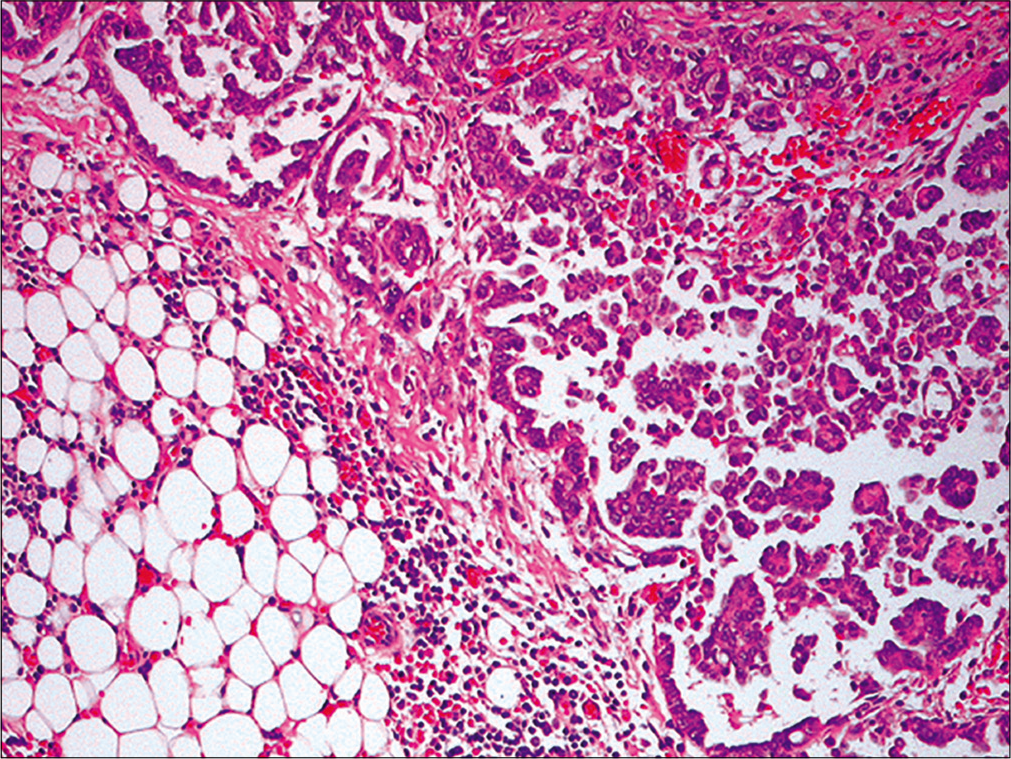 Metastatic ovarian carcinoma. Section from omentum reveals metastatic ovarian papillary serous carcinoma (Omentectomy, HE, 100X)