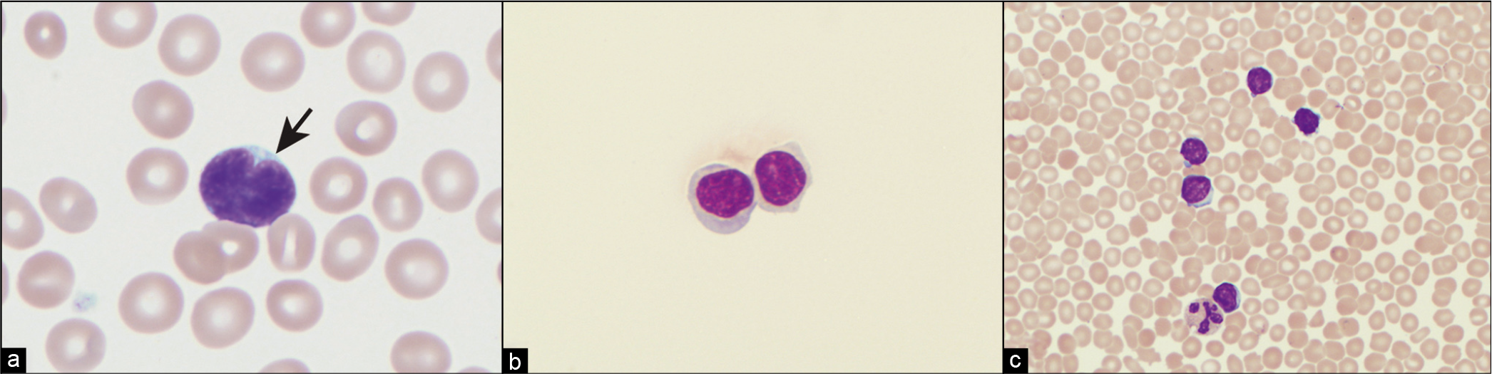 (a) Follicular lymphoma lymphocyte with characteristic cleaved or notched nucleus (arrow). (b) CLL cells in pleural fluid Cytospin preparation. (c) Bloody pleural fluid in a patient with CLL. Contamination with peripheral blood must be considered before diagnosing a patient as having pleural fluid involvement with CLL.