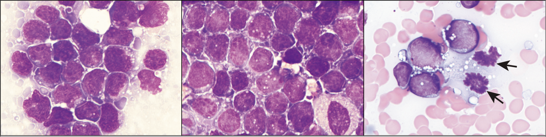 Burkitt lymphoma, ascitic fluid; monomorphous population of medium-sized cells with prominent cytoplasmic vacuolization. Note the mitoses in C (arrows). [DQ stain].