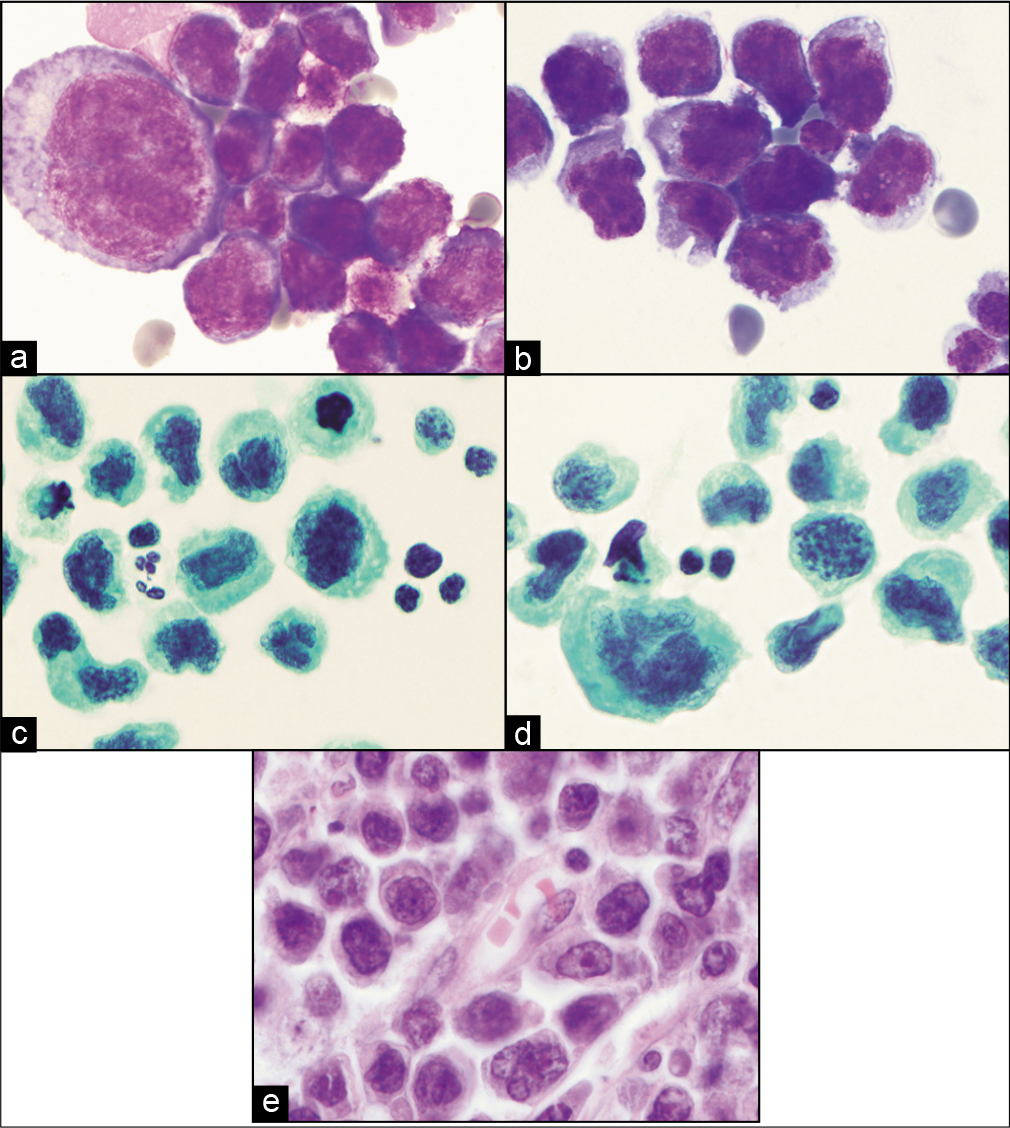 (a,b) DQ-stained cytology smears from ascitic fluid showing large atypical lymphoid cells later proved to be diffuse large B-cell lymphoma. (c,d) PAP-stained cytology smears showing same cells as in a and b. (e) Histology section from same patient with malignant effusion showing primary colonic diffuse large B-cell lymphoma.