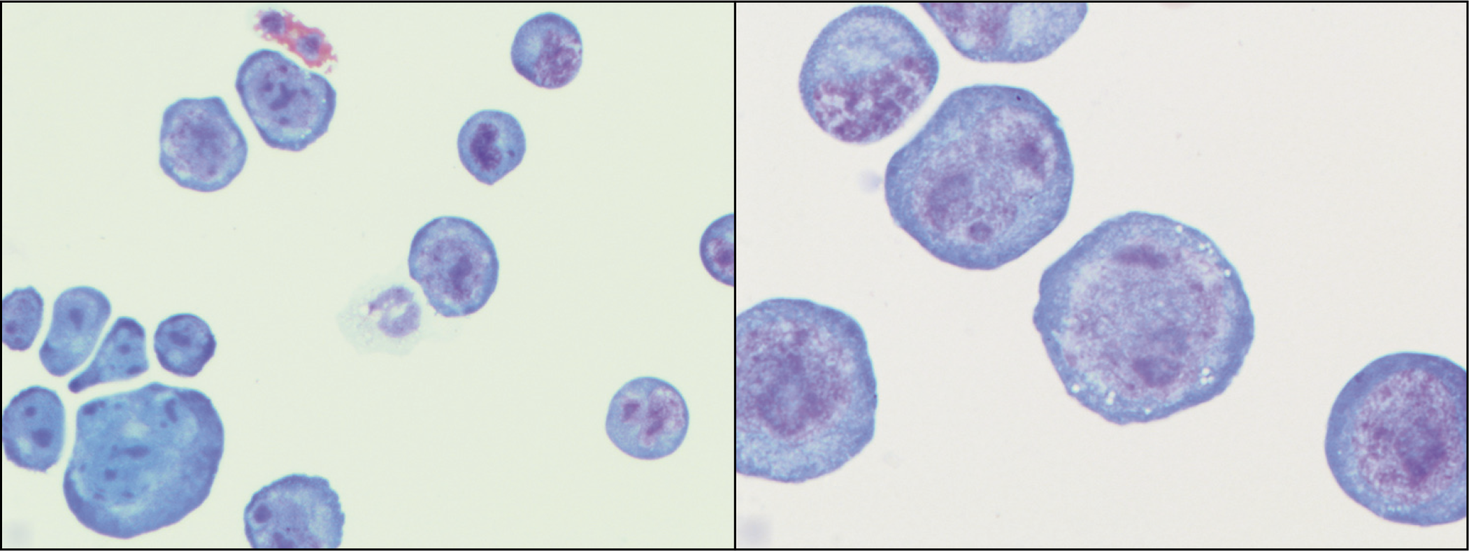 HHV-8 positive primary effusion lymphoma (ascitic fluid). The specimen shows monomorphic, dispersed, medium to large cells with moderate amount of basophilic cytoplasm with scant cytoplasmic vacuoles. Nuclei are round to slightly irregular with fine chromatin and variable prominence of nucleoli. [Wright–Giemsa stain.]