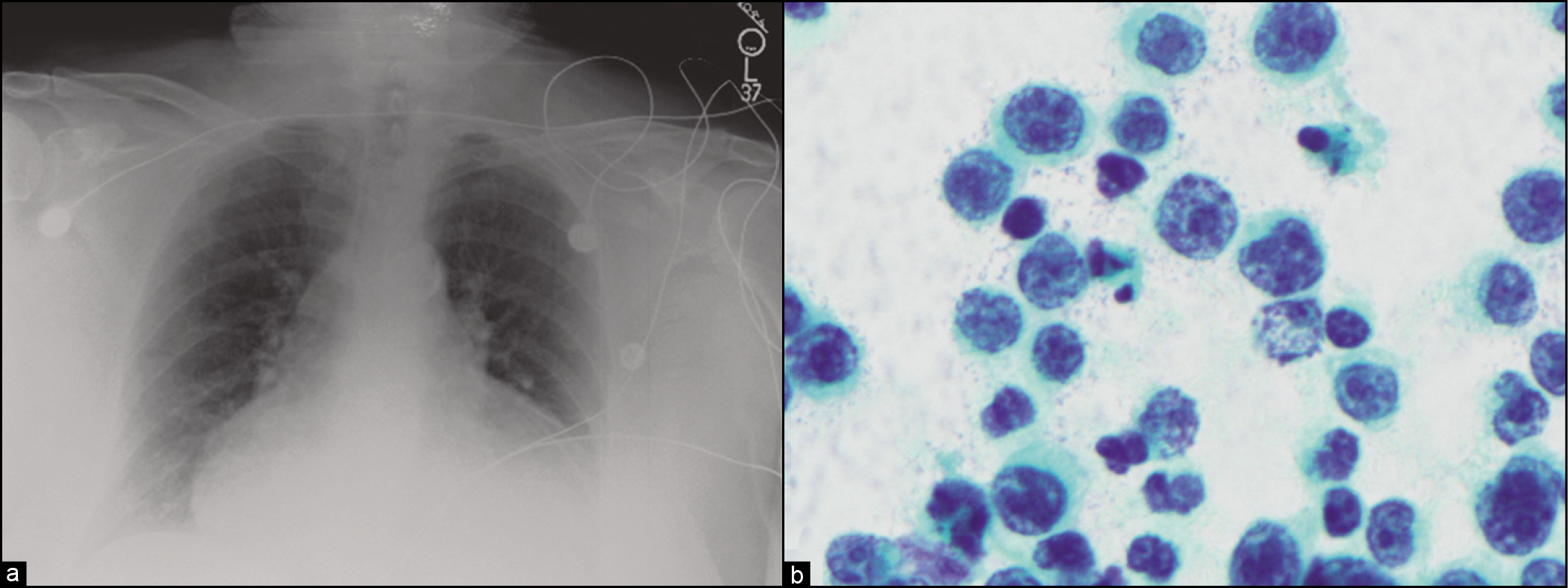 (a) Chest radiograph showing cardiomegaly in a patient with severe dyspnea and massive malignant pericardial effusion. (b) Pericardial fluid cytology, in patient from (a), presenting with primary cardiac lymphoma and isolated massive pericardial effusion. This case turned out to be diffuse large B-cell lymphoma.