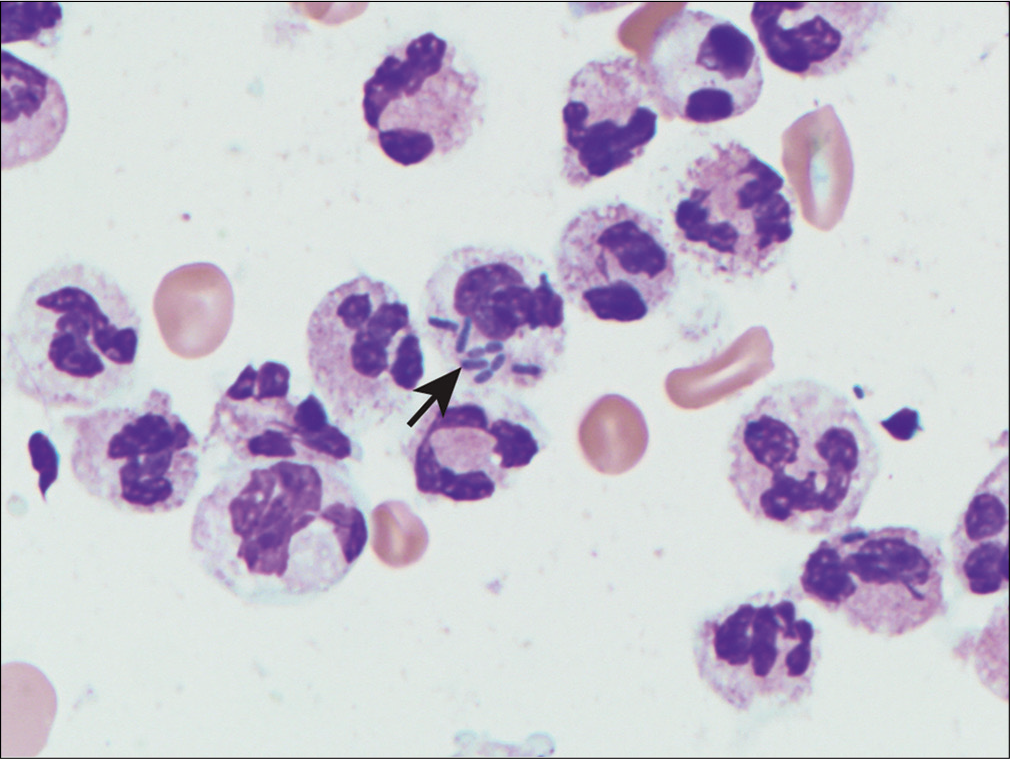 Neutrophils with intracellular bacteria (arrow) in neutrophilic peritonitis.