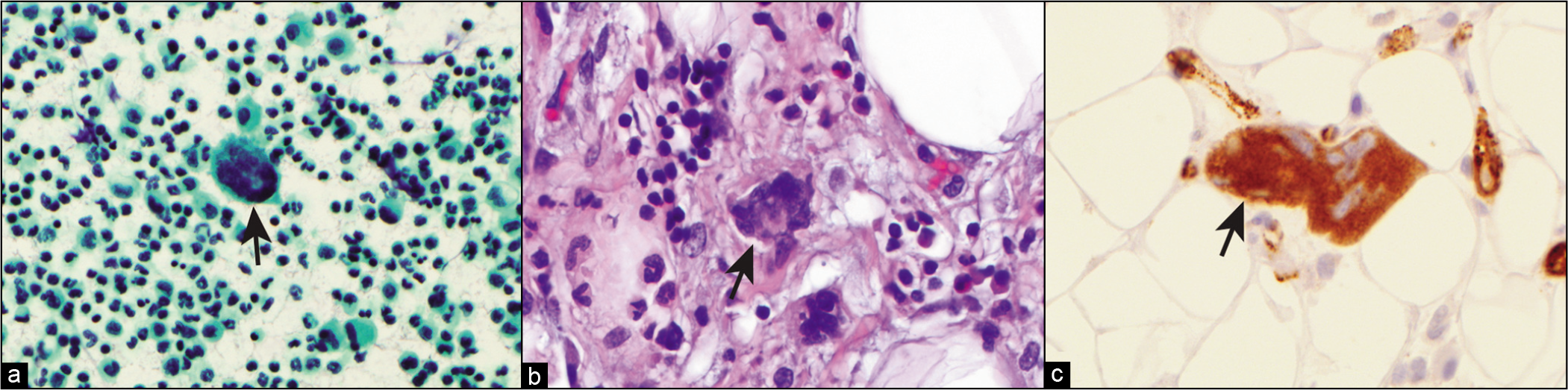 (a) PAP-stained cytology smear from ascitic fluid showing megakaryocyte (arrow). (b) Tissue section from subsequent biopsy showing megakaryocytes in extramedullary hematopoiesis. (c) Tissue section with factor VIII immunohistochemistry staining of megakaryocyte.