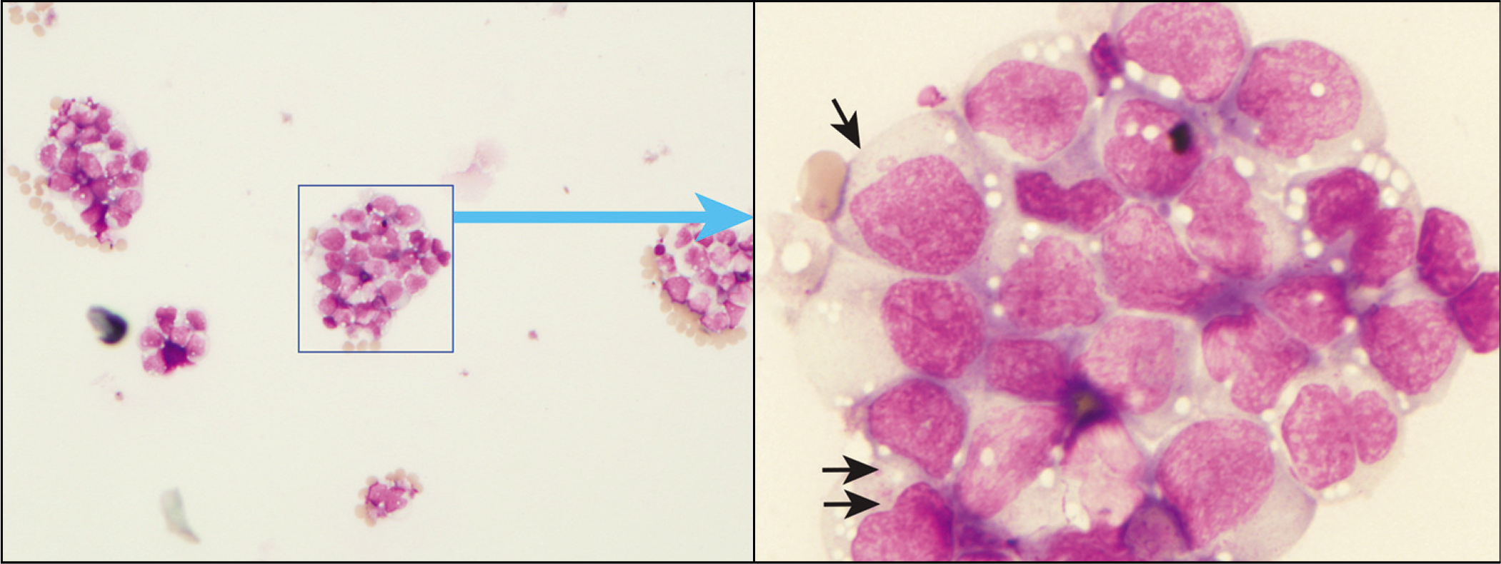 Clusters of blasts and immature myeloid cells with cytoplasmic granules (arrows) and irregular nuclei in myeloid sarcoma.