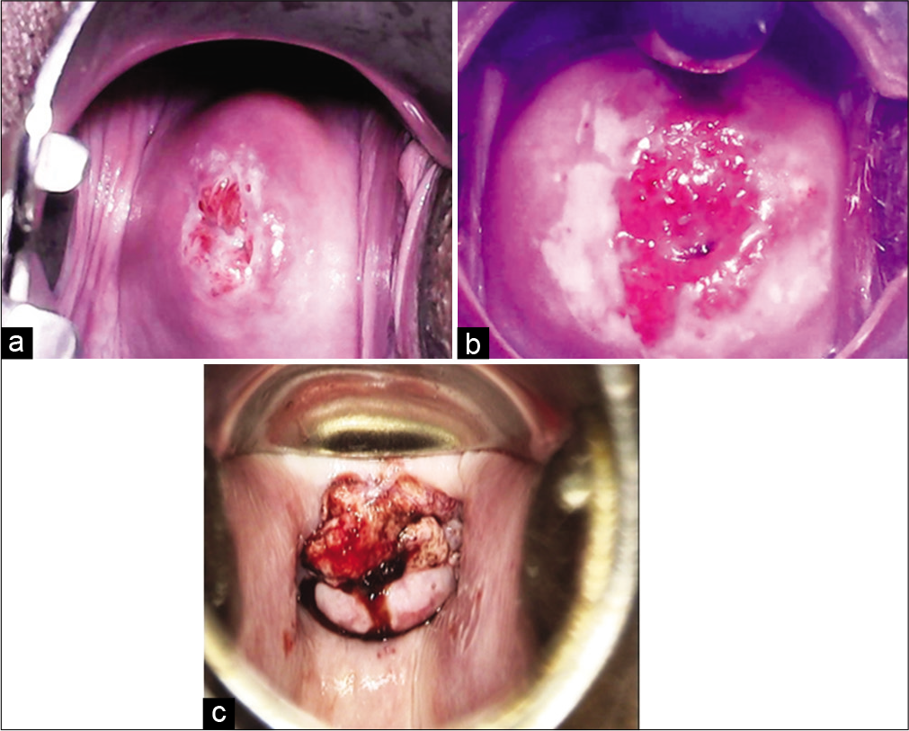 Visual inspection on acetic acid outcome categories. (a) VIA – Negative, (b) VIA – Positive, (c) VIA - Suspicious of invasive cancer.