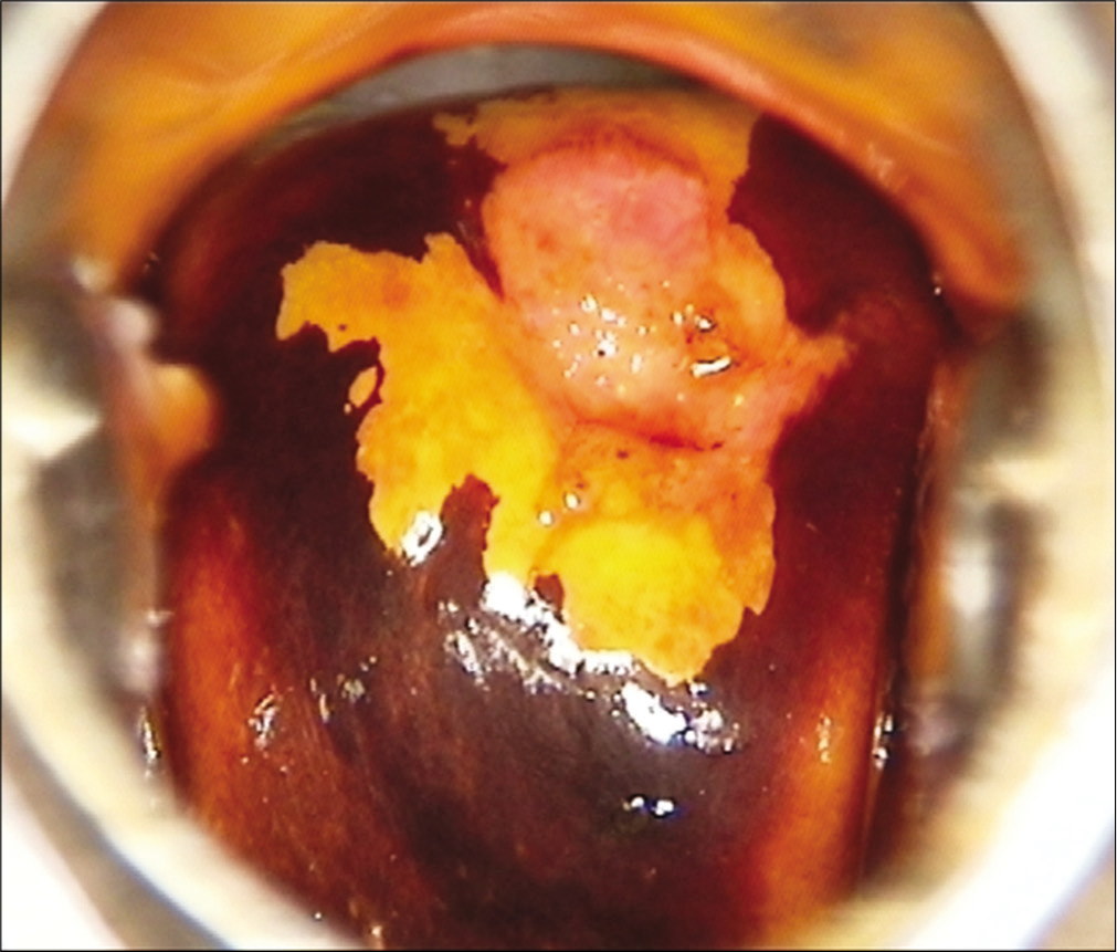 Bright yellow Iodine negative area after application of Lugol’s Iodine.