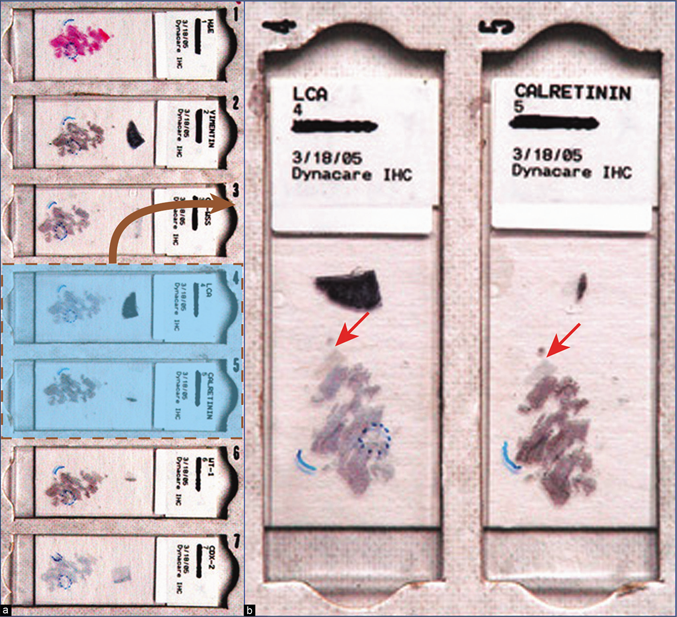 Metastatic colonic adenocarcinoma, peritoneal fluid. a. Serial sections of cell-blocks oriented identically on all slides in a sequential order. The respective numbers identify their relative position with each other: 1, HE; 2, vimentin; 3, cytokeratin; 4, LCA (CD45); 5, calretinin; 6, WT-1; 7, CD-X2. b. Enlarged view showing slide numbers 4 and 5, emphasizing identical orientation (arrows) of cell-block sections on all glass slides. Identical orientations of all serial sections facilitate immunocytochemical evaluation with the SCIP approach. If not properly organized in this fashion, it may be impossible in effusion specimens with a predominance of small cell groups and solitary cells to evaluate the coordinate immunoreactivity pattern in relation to various immunomarkers.