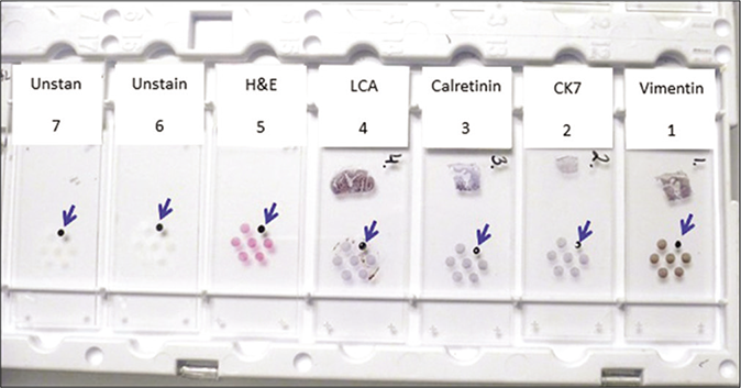 Cell-blocking (with NGCBTM kit) and AV marker: subtractive coordinate immunoreactivity pattern (SCIP) approach. Identical orientation of all sections on glass slides with proper labeling of their exact sequence in relation to each other. From Open Access publication: CytoJournal 2021;18:2. https://dx.doi.org/10.25259/Cytojournal_83_2020