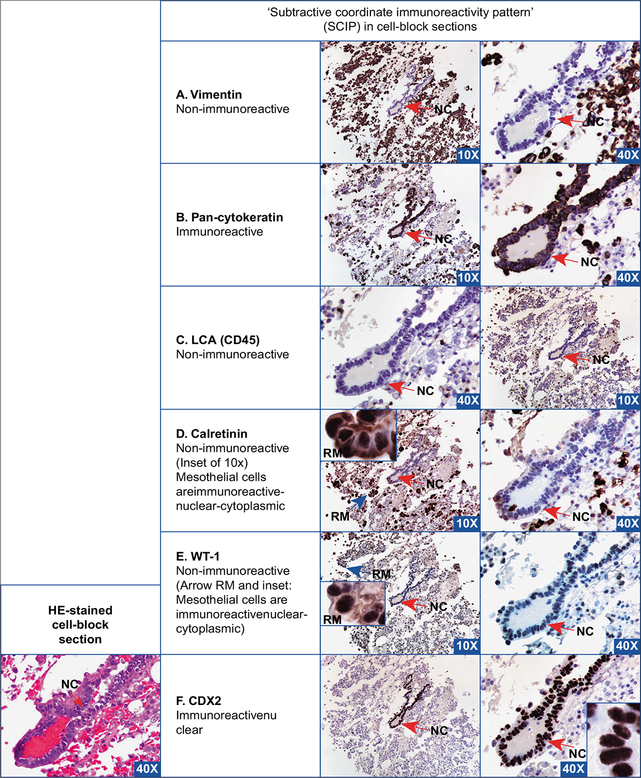 Metastatic colonic adenocarcinoma, peritoneal fluid. The neoplastic cells (red arrow NC) are immunoreactive for pan-cytokeratin (B) and non-immunoreactive for vimentin (A), CD45 (C), calretinin (D), and WT-1 (E). They have nuclear immunoreactivity for CDX2 (F), which is consistent with a colonic primary. The reactive mesothelial cells [with immunoreactivity for calretinin (nuclear-cytoplasmic) (D), WT-1 (nuclear-cytoplasmic) (E), vimentin (A)] and inflammatory cells [with immunoreactivity for vimentin (A) and LCA (C) ] in the background can be subtracted from neoplastic cells to deduce a diagnostic coordinate immunoreactivity pattern. LCA, leukocyte common antigen; NC, neoplastic cell; RM, reactive mesothelial cell; WT-1, Wilms’ tumor1. [A–F, Immunostained cell-block sections.]