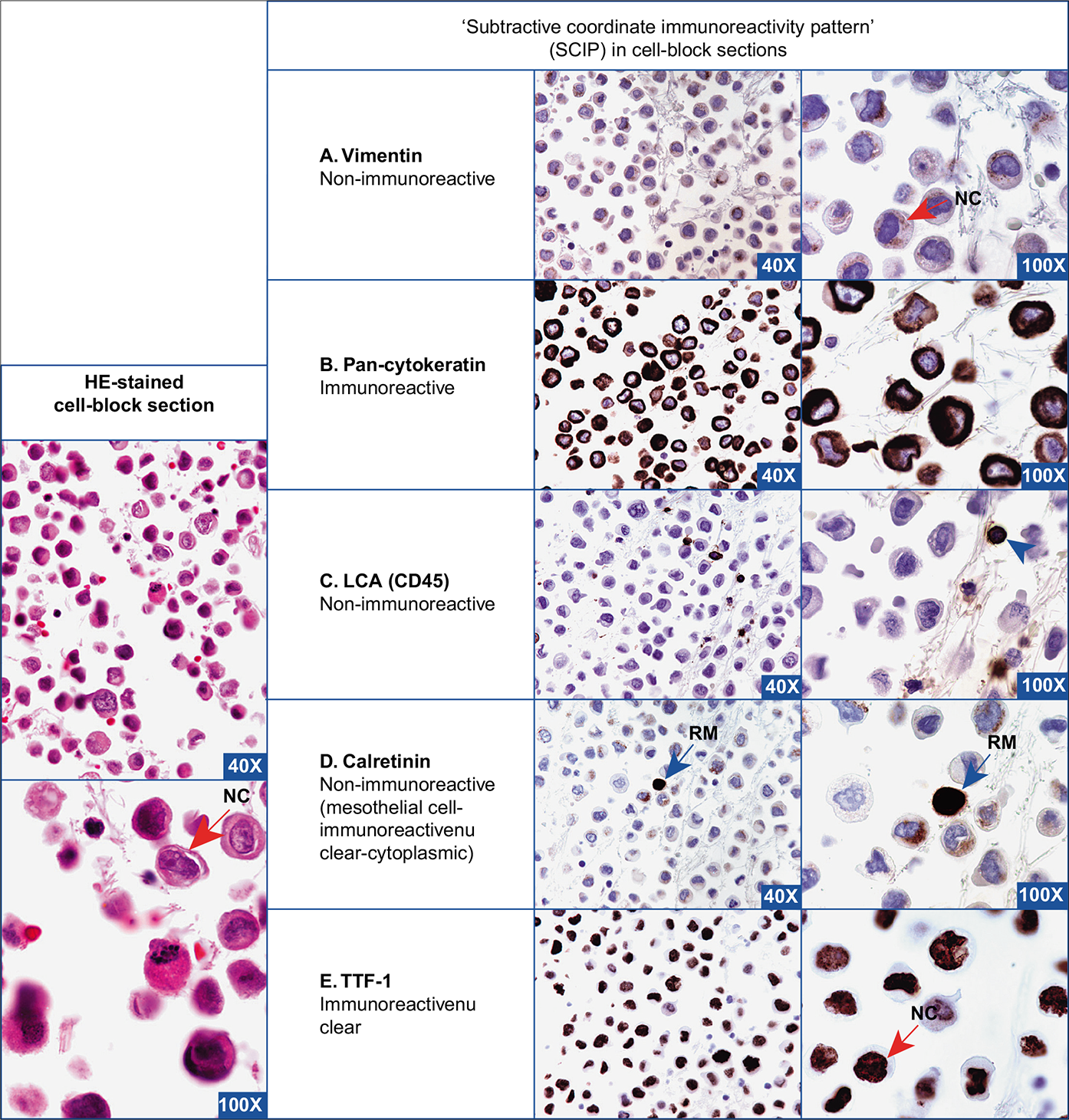 Metastatic lung carcinoma, pleural fluid. The specimen shows scattered solitary neoplastic cells (red arrows NC) with rare mesothelial cells (blue arrow RM). The neoplastic cells are immunoreactive for pan-cytokeratin (B) and non-immunoreactive for vimentin (A), LCA (C), and calretinin (D). Rare reactive mesothelial cells (blue arrow RM) [with immunoreactivity for calretinin (nuclear-cytoplasmic) (D)] and inflammatory cells (arrowhead) [with immunoreactivity for LCA (C)] in the background can be subtracted from the neoplastic cells to deduce a diagnostic coordinate immunoreactivity pattern. This is consistent with poorly cohesive singly scattered carcinoma cells, which were also non-immunoreactive for the melanoma marker. Nuclear immunoreactivity for TTF-1 (E) with a clinical history of lung mass is consistent with a lung primary. NC, neoplastic cell; RM, reactive mesothelial cell; TTF-1, thyroid transcription factor-1. [A–E, Immunostained cell-block sections.]