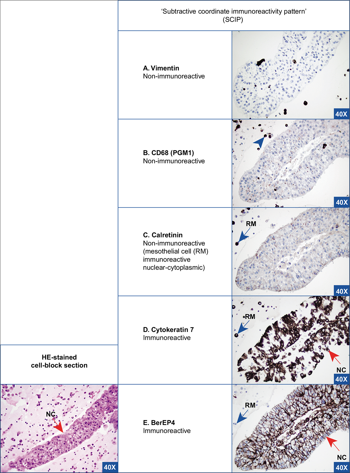 Metastatic mammary adenocarcinoma, pleural effusion. Specimen with proliferation spheres. The neoplastic cells (red arrows NC) are immunoreactive for cytokeratin 7 (D) and BerEP4 (E). They are non-immunoreactive for vimentin (A), CD68 (B), and calretinin (C). Rare mesothelial cells (blue arrow RM) [with immunoreactivity for vimentin (A), calretinin (nuclear-cytoplasmic) (C), and cytokeratin 7 (D)] and inflammatory cells (arrowheads) [with immunoreactivity for vimentin (A) and CD68 (C)] in the background can be subtracted from the neoplastic cells to deduce a diagnostic coordinate immunoreactivity pattern. Cytokeratin 7 immunoreactivity with a clinical history of mammary carcinoma is consistent with a breast primary. NC, neoplastic cell; RM, reactive mesothelial cell. [A–E, Immunostained cell-block sections.]