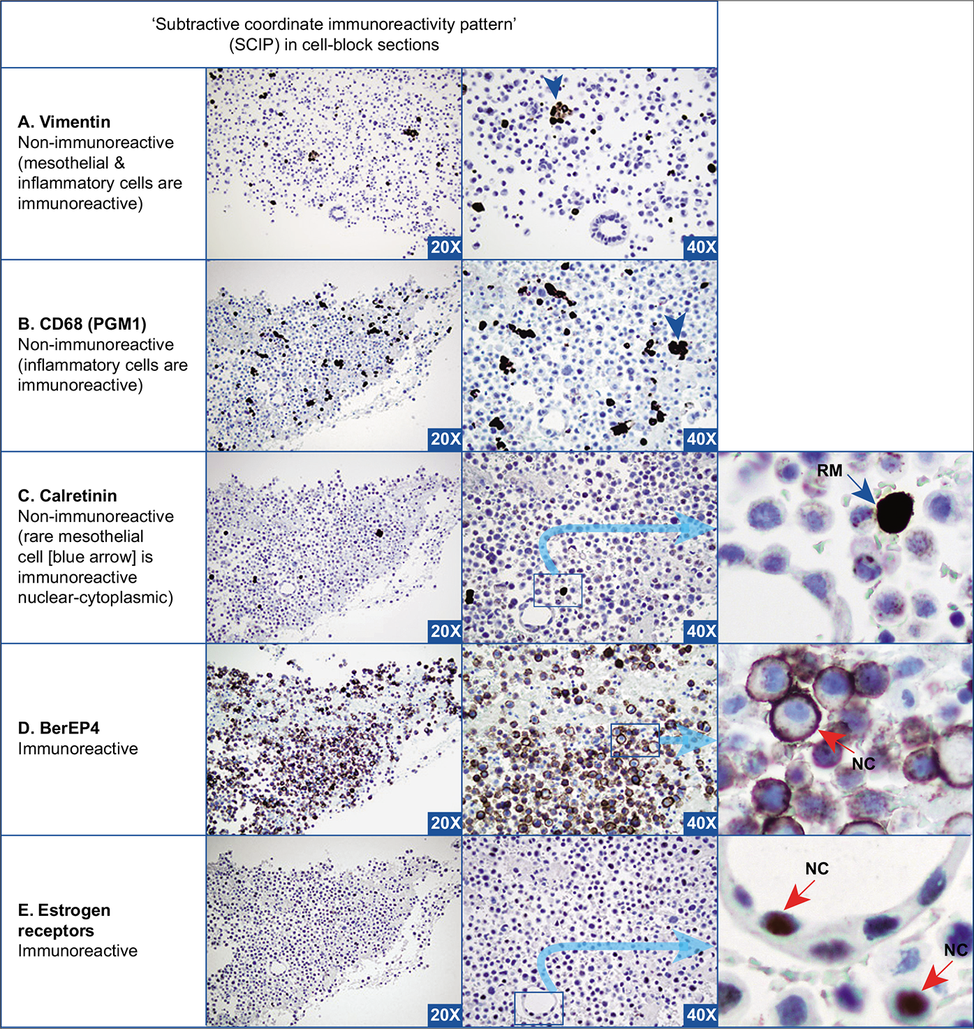 Metastatic mammary adenocarcinoma, pleural effusion. Specimen with solitary neoplastic cells as the predominant population. The neoplastic cells (red arrows NC) are immunoreactive for BerEP4 (D) and estrogen receptors (E). They are non-immunoreactive for vimentin (A), CD68 (B), and calretinin (C). Rare mesothelial cells (blue arrow RM) [with immunoreactivity for vimentin (A) and calretinin (nuclear-cytoplasmic) (C)] and inflammatory cells (arrowheads) [with immunoreactivity for vimentin (A) and CD68 (B)] in the background can be subtracted from the neoplastic cells to deduce a diagnostic coordinate immunoreactivity pattern. Immunoreactivity for ER with a clinical history of mammary carcinoma is consistent with a breast primary. ER, estrogen receptors; NC, neoplastic cell; RM, reactive mesothelial cell. [A–F, Immunostained cell-block sections.]