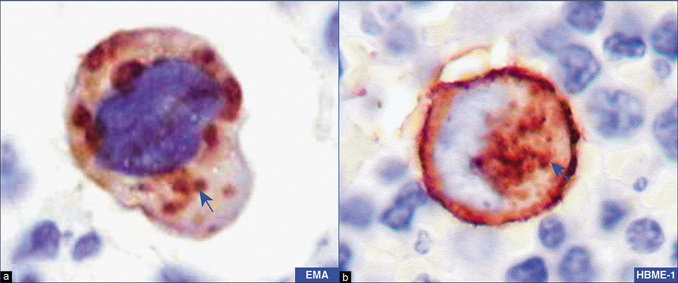 Adenocarcinoma, peritoneal fluid. Neoplastic cells are immunoreactive for EMA (a) and HBME-1 (b) with a cytoplasmic immunostaining pattern (arrows) with focal blotchy immunostaining along the cell membrane. Compare Figure 16 with membranous immunostaining highlighting the microvilli in mesothelial cells. [a,b, Immunostained cell-block sections (a,b, 100X zoomed).]