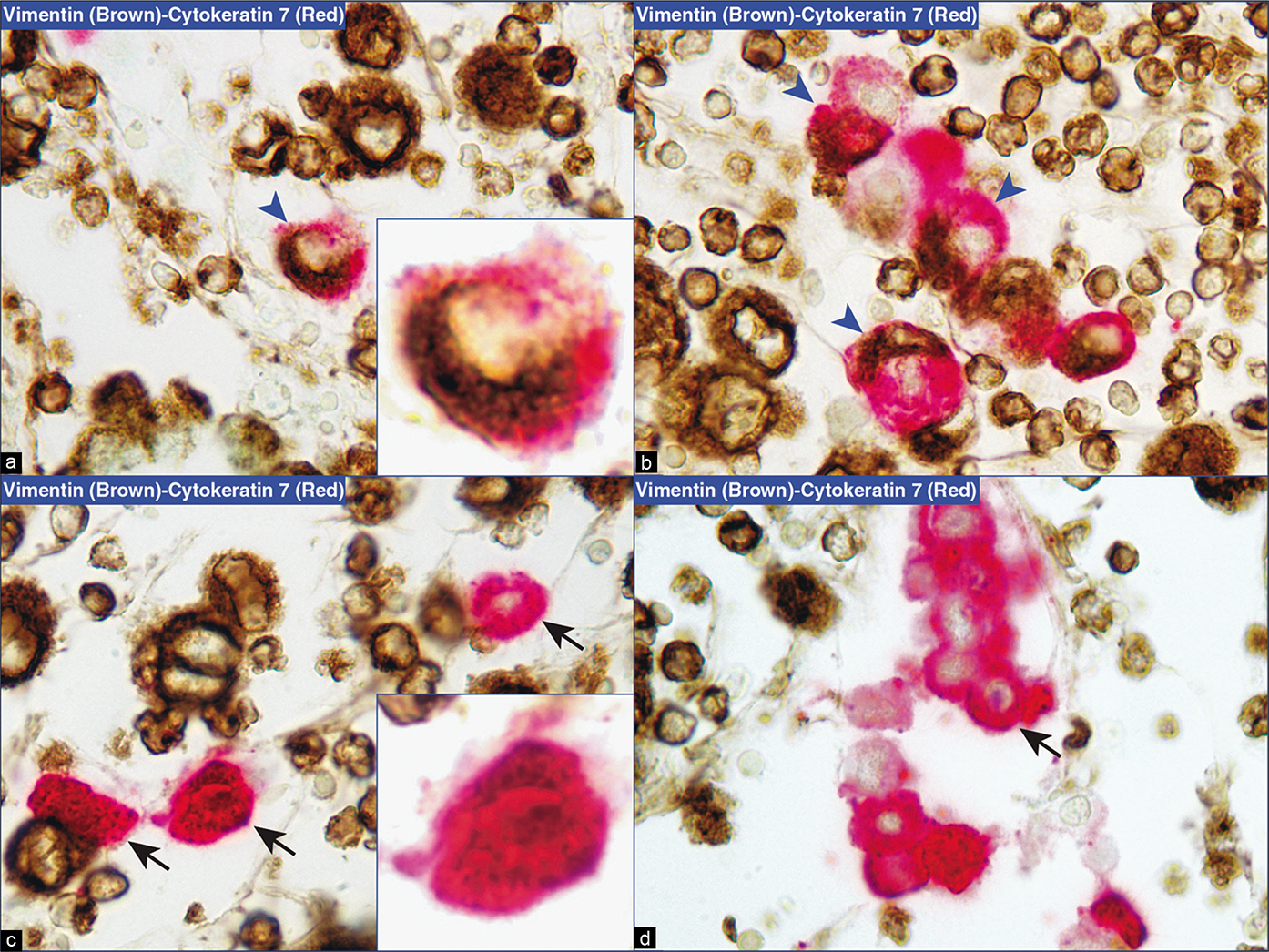 SCIP with dual color immunostaining (metastatic mammary carcinoma, effusion fluid). Reactive mesothelial cells (blue arrowheads in a,b) are immunoreactive for both vimentin (brown) and cytokeratin 7 (red) (inset of a). The metastatic carcinoma cells (arrows), both isolated (c) and small cohesive groups (d), do not show immunostaining for vimentin (no brown color) but only immunostaining for cytokeratin 7 (red) (inset of c). The corresponding cells in adjacent serial section with dual color immunostaining were also negative for calretinin (brown) but immunoreactive for BerEP4 (red) (not shown here). As expected, the background inflammatory cells are highlighted with vimentin (brown) immunostaining only; they are negative for cytokeratin 7 (red) (a,b,c,d). [a–d, Dual color immunostained cell-block sections—vimentin (brown) followed by cytokeratin 7 (red), (a–d 100X).]