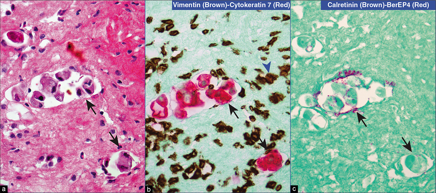 Metastatic mammary adenocarcinoma, pleural fluid. Metastatic carcinoma cells (arrows in a–c) are immunoreactive only for cytokeratin 7 (red) without vimentin (brown) immunostaining (b). For additional confirmation, these cells are weakly immunoreactive for BerEP4 (red) and negative for calretinin (brown) (c). As expected, the background inflammatory cells (blue arrowhead in b) are highlighted with vimentin (brown) only; they are negative for cytokeratin 7 (red) (b). As noted in c, the reactive mesothelial cells were rare in this specimen. [a, HE-stained section; b, vimentin (brown) followed by cytokeratin 7 (red) (dual color immunostained cell-block section); c, calretinin (brown) followed by BerEP4 (red) (dual color immunostained cell-block section); (a–c, 40X).]