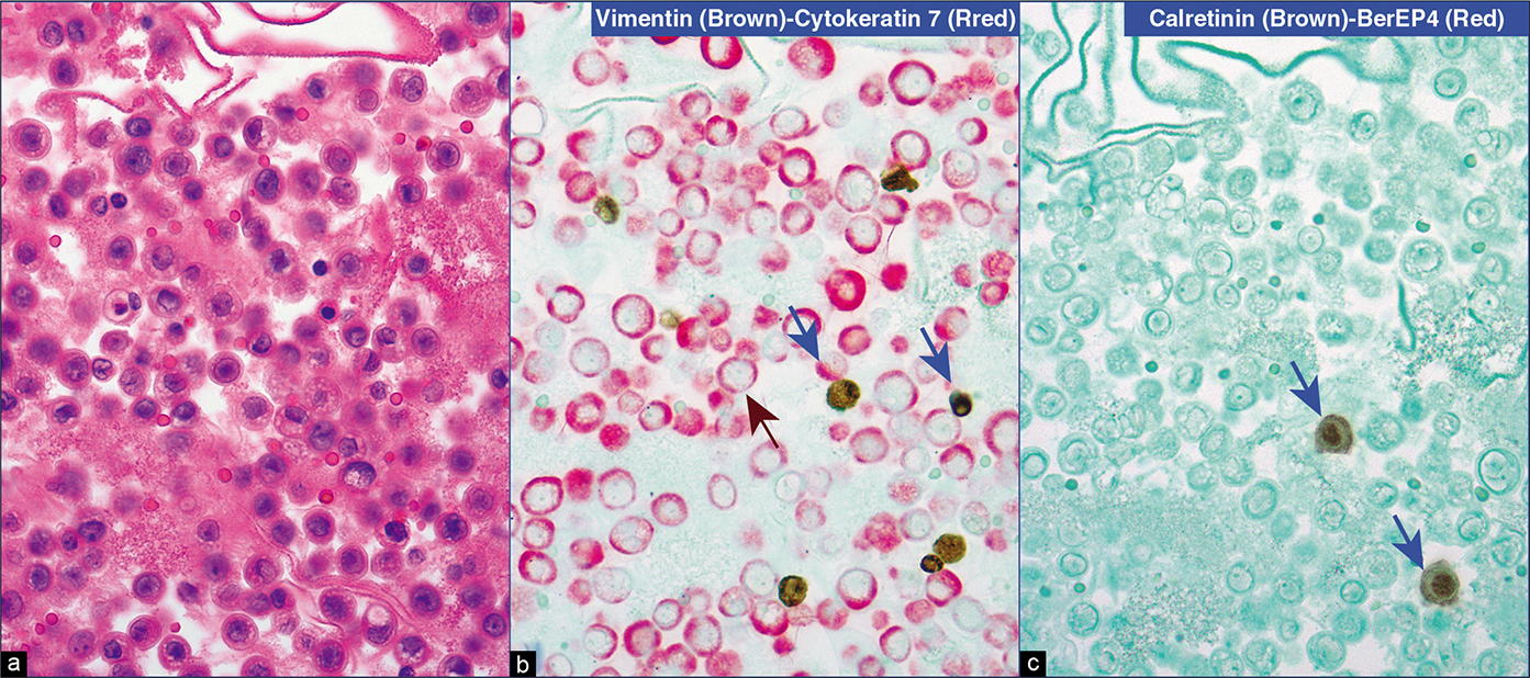 Metastatic gastric adenocarcinoma, peritoneal fluid. The metastatic carcinoma cells are only immunoreactive for cytokeratin 7 (red) (brown arrows in b). Vimentin (brown) immunoreactive inflammatory cells (blue arrows in b) and the reactive mesothelial cells with calretinin nuclear immunoreactivity (brown) (blue arrow) are seen in the background (c). These inflammatory cells (blue arrows in b) and the reactive mesothelial cells (blue arrow) are negative for cytokeratin 7 (red) and BerEP4 (red) in b and c, respectively. Discussion in brief. Numerous isolated neoplastic cells as predominant population (a) suggested a differential diagnosis of high-grade large cell lymphoma and mesothelial cells with florid reactive changes. Immunoreactivity for cytokeratin 7 (brown arrow) in b excluded lymphoma and concurrent lack of vimentin (brown) immunostaining excluded mesothelial cells. The patient had a history of gastric carcinoma. The pattern was consistent with metastatic gastric carcinoma. A few vimentin immunoreactive (brown) inflammatory cells were present in the background (b). Rare reactive mesothelial cells with brown nuclear and cytoplasmic immunostaining (blue arrows) were also present in the background with inflammatory cells (c). The metastatic cells were also weakly immunoreactive for BerEP4 by one color immunostaining, but this weak immunoreactivity was not detectable in the dual color immunostained sections even after using the same titer of antibody dilution used for routine one color immunostaining (c) [30a] [a, HE-stained section; b, vimentin (brown) followed by cytokeratin 7 (red) (dual color immunostained cell-block section); c, calretinin (brown) followed by BerEP4 (red) (dual color immunostained cell-block section); (a–c, 40X).]