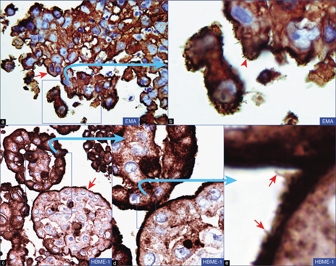 Diffuse malignant mesothelioma of epithelial type (DMME), pleural fluid. Neoplastic cells are immunoreactive for EMA (a,b) and HBME-1 (c,d,e) with a membranous immunostaining pattern (arrows) highlighting long, slender microvilli (arrowheads). [a–e, Immunostained cell-block sections (a, 100X; b, 100X zoomed; c, 40X; c, 100X; e, 100X zoomed).]