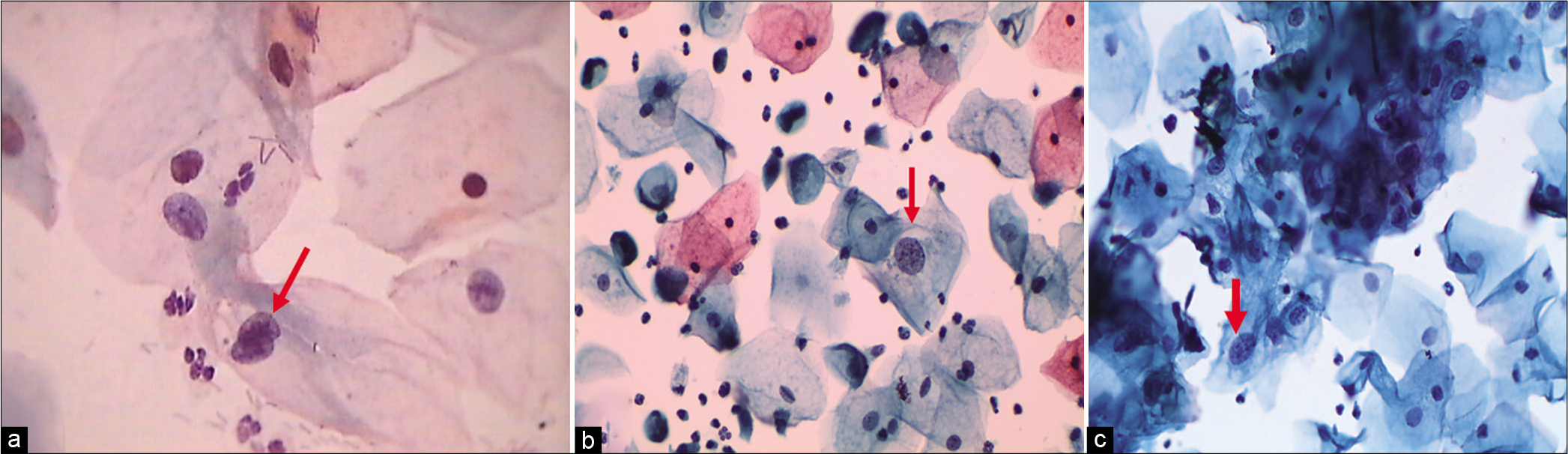 (a) CP, (b and c) LBC: Increased nuclear-to-cytoplasmic ratio (red arrow). The nuclei are slightly enlarged and this enlargement is compared to the unequivocally normal nucleus of the same cell type. Other minimal nuclear changes include hyperchromasia, chromatin clumping, irregularity, and binucleation ×40.