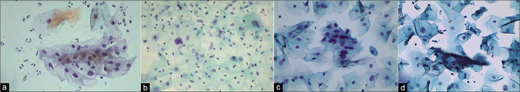 (a and b) CPS: Nuclear smudging and multinucleation, respectively (×40). (c and d) LBC: Nuclear hyperchromasia and chromatin clumping, respectively (×40).