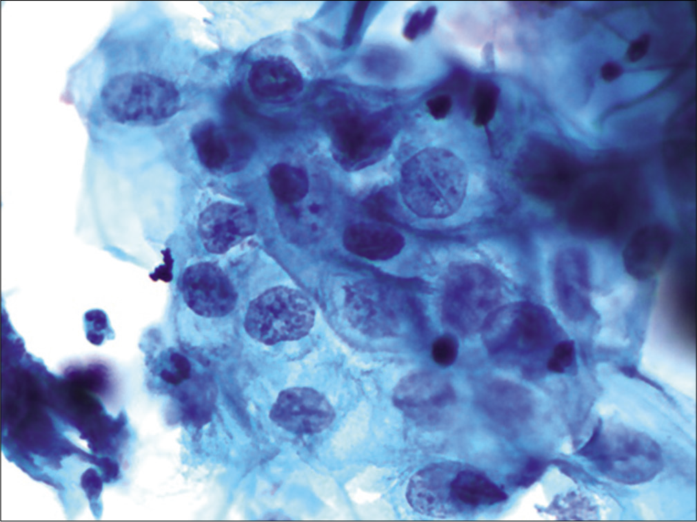 LBC: ASC-US. Slight nuclear membrane irregularities in an occasional nucleus (×40).