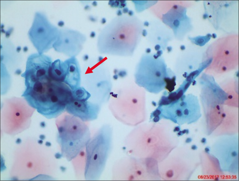 LBC smear from a 23-year-old woman. A cluster of intermediate cells is seen with nuclear enlargement 2 − 3 times that of normal intermediate squamous cell nucleus. There is partial haloing of cytoplasm with slight nuclear crenation and hyperchromasia that do not meet the diagnostic criteria for LSIL. A repeat cervical cytology showed similar findings. hrHPV DNA test was positive.