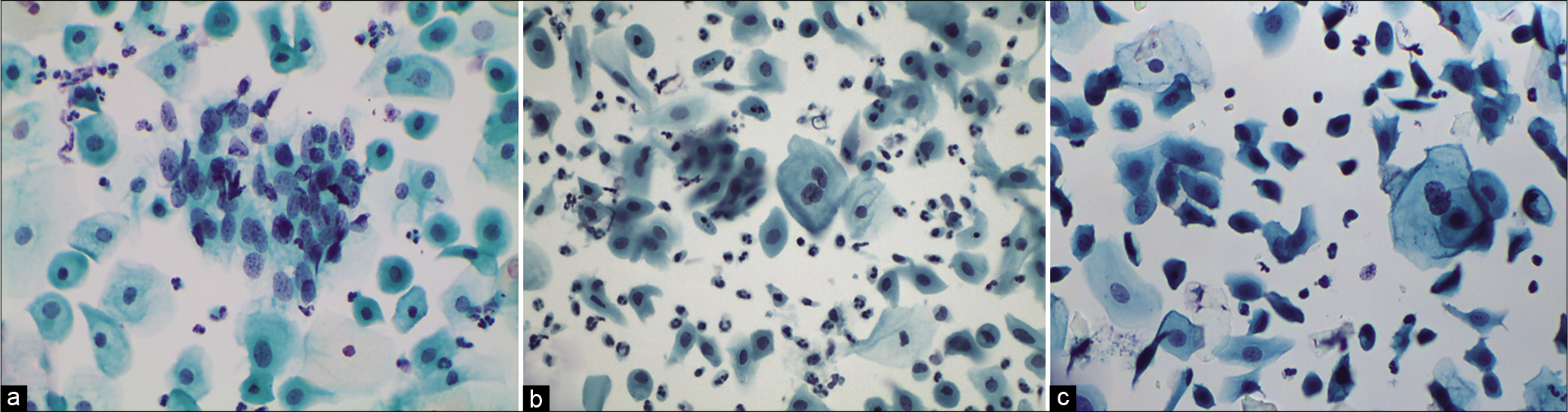 (a-c) LBP. ASC-US in atrophy. Multinucleation, nucleomegaly, and hyperchromasia can be seen in mature cells (intermediate or superficial) and may mimic ASC-US. Mild nuclear enlargement without significant hyperchromasia or nuclear irregularity (a) (×40).