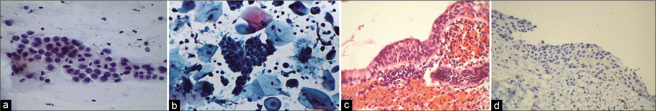 (a) CPS: Deep parabasal and basal cells being scraped from thinned out atrophic epithelium can mimic cells of HSIL (×40). (b) LBC: Smear showing granular muck in the background, typically seen in an atrophic smear, with hyperchromatic parabasal cells, should not be confused with HSIL and necrosis (×40) (c) (H and E stain) showing SCJ and a thin layer of parabasal cells with high N/C ratio creating suspicion of HSIL. (d) IHC of the same for p16 which is negative (×40).