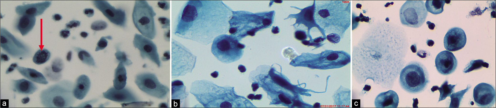 (a-c) LBC: Immature metaplastic cells with nuclear atypia favoring atypical repair. (×40). (a) Mitotic figure (red arrow), (b) nuclear enlargement and inflammatory cells overlapping metaplastic cells favor a reactive process, (c) smaller and rounder metaplastic cells in atypical repair (×40).