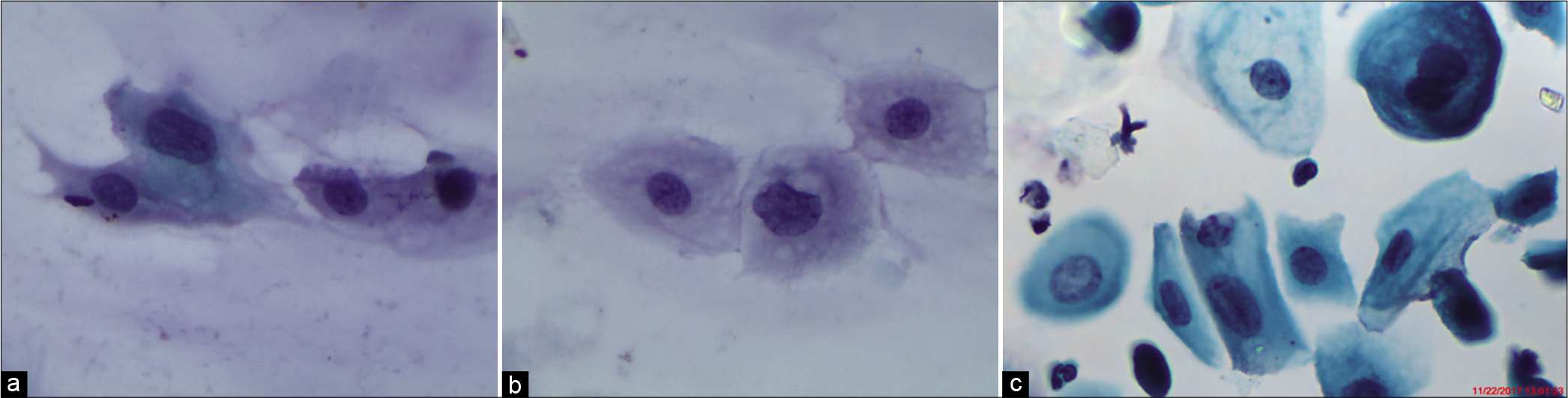 (a-b) CPS: Immature metaplastic cells showing high N/C ratio (×40). (c) LBC: Features of ASC-US in little more mature metaplastic cells. Nuclear enlargement and binucleation are seen (×40).