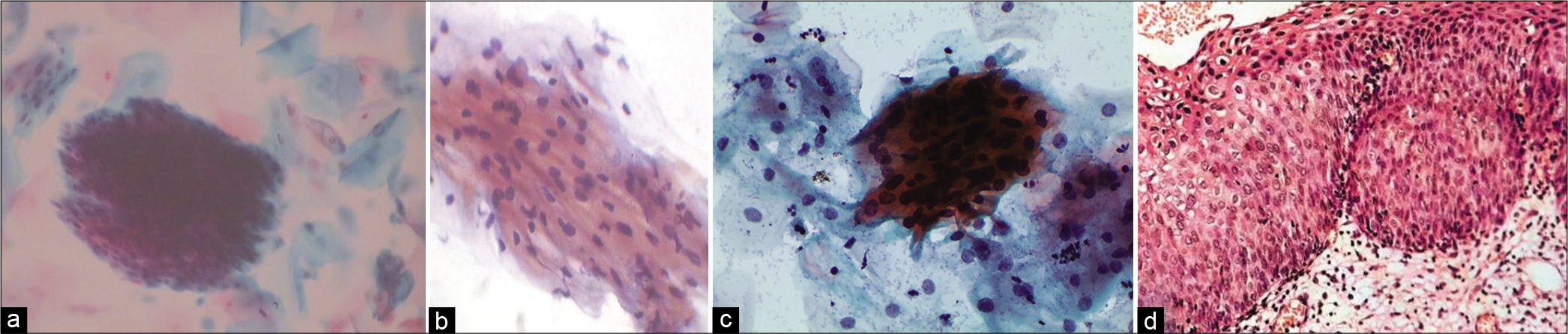 (a and c) LBC. (b) CPS. Atypical parakeratotic cells qualify for ASC category. Smears showing stacks of miniature mature keratinized cells with pleomorphic nuclei (×40). (d) Tissue biopsy showing pleomorphic parakeratotic cells camouflaging the underlying HSIL (×40).