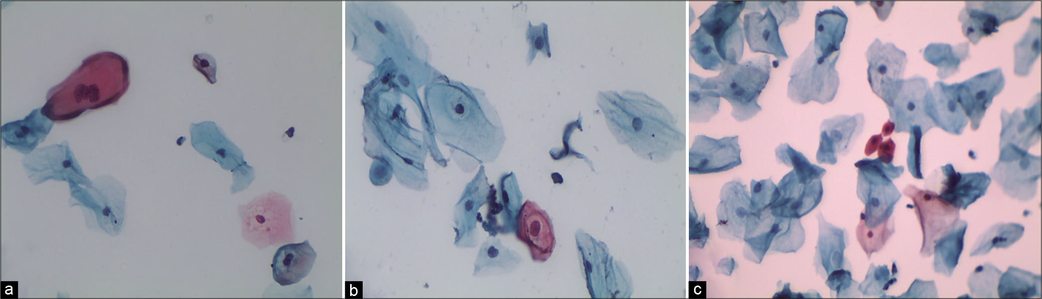 LBC (a) Smear showing dyskeratotic cell with binucleation. (b) Single dyskeratotic cell with partial haloing of cytoplasm. (c) Dyskeratotic cells with dense pyknotic nuclei (×40).