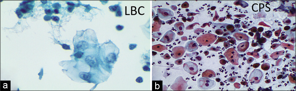 (a) LBC – Poor preservation of cells. (a) Vacuolar degeneration and pale enlarged degenerated nuclei. (b) CP – Drying artifact, leading to polychromasia and dark staining of the nucleus, in a CPS from a case of atrophy. Such smears may be falsely labeled as ASC-US (×40).