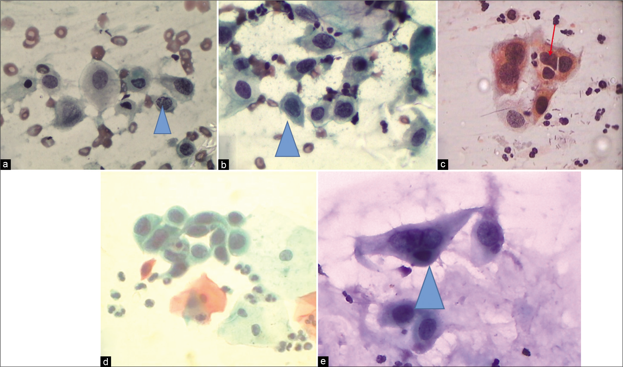 CP – Examples of cells labeled as ASC-H. (a) Single cell at the arrow is showing high N/C ratio, hyperchromatic nucleus, and coarse chromatin. (b) Significant nuclear enlargement (1.5–2 times that of a normal metaplastic cell) with atypia. (c) Nuclear enlargement, abnormal nuclear shapes, and hyperchromasia of metaplastic cells. (d) Sheet of highly atypical metaplastic cells. However, sharp cytoplasmic outlines such as intercellular junctions as against syncytial clusters of HSIL are seen. Therefore, ASC-H is an appropriate interpretation (×40). (e) ASC-H in a metaplastic squamous cell.