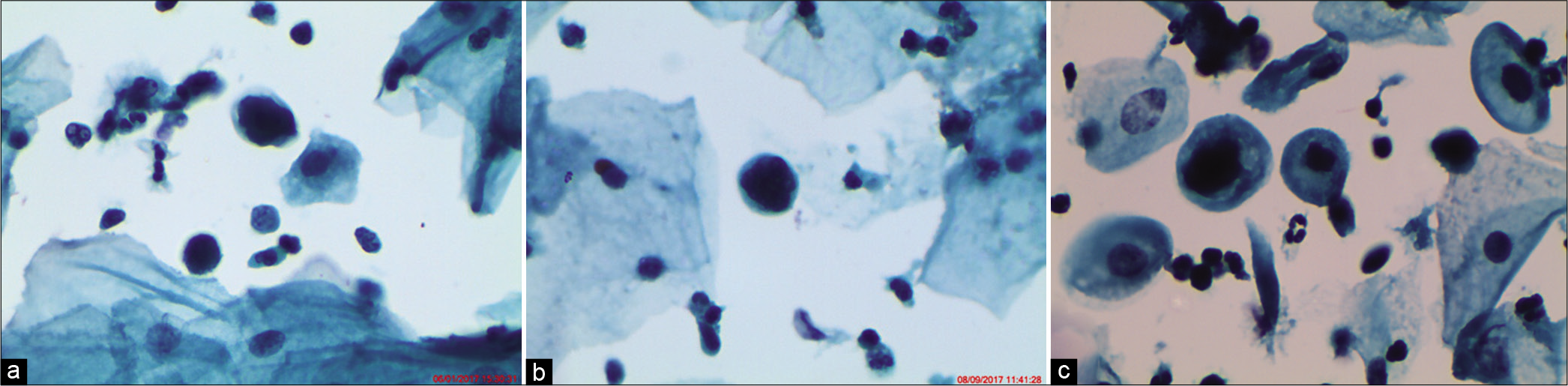 (a-c) LBC smear from a 36-year-old woman. Single small round immature metaplastic cells. Cells are the size of metaplastic cells with nuclei that are about 1.5–2.5 times larger than normal (×40).