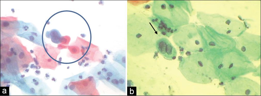 (a and b) CPS. Single small cells with nuclear features favoring HSIL but their number are very less in the smear also known as “litigation cells.” Such cells have been picked by automated screening devices (×40).