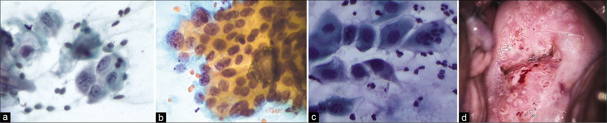 (a-d) CPS (×40) – Immature metaplastic cells in a reactive process show nucleoli, smooth membranes (a and b), and inflammatory cells either engulfed by these reactive cells. (c) Follow-up colposcopy. (d) Thick metaplastic islands around glandular openings and there was no evidence of CIN lesion.