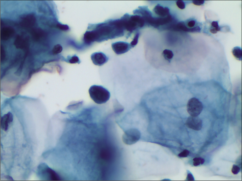 LBC – Small single cells creating a suspicion of HSIL because of high N/C ratio, thick nuclear membrane, and hyperchromasia. Such few single cells without any syncytial clusters in rest of the smear qualify for an ASC-H (×40). HPV DNA test was positive in this patient. However, the patient did not turn up for colposcopy.