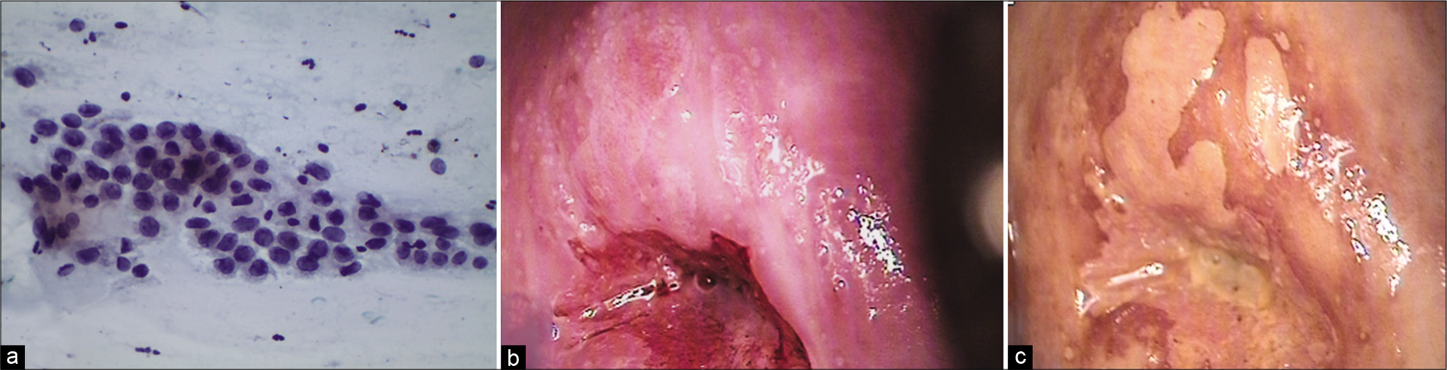 (a-c) CPS – ASC-H in atrophy. Parabasal cells showing features suggestive of HSIL like increase in N/C ratio and hyperchromasia but there is regular pacing between the cells and nuclear outlines are smooth (×40). A diagnosis of ASC-H may be appropriate. Follow-up colposcopy (b and c) favored a HSIL.