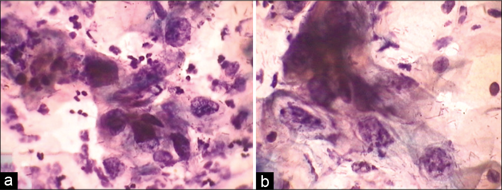 (a and b) CPS. SIL grade cannot be determined. (a and b) HPV may be associated with exuberant nucleomegaly which enables one to gauge the maturity of the cell. Furthermore, the nuclei are highly pleomorphic. This was a pregnant woman, cervix was unremarkable, so after seeing this smear we did her HPV DNA testing and it was positive for high-risk viruses. Colposcopy showed features of LSIL.