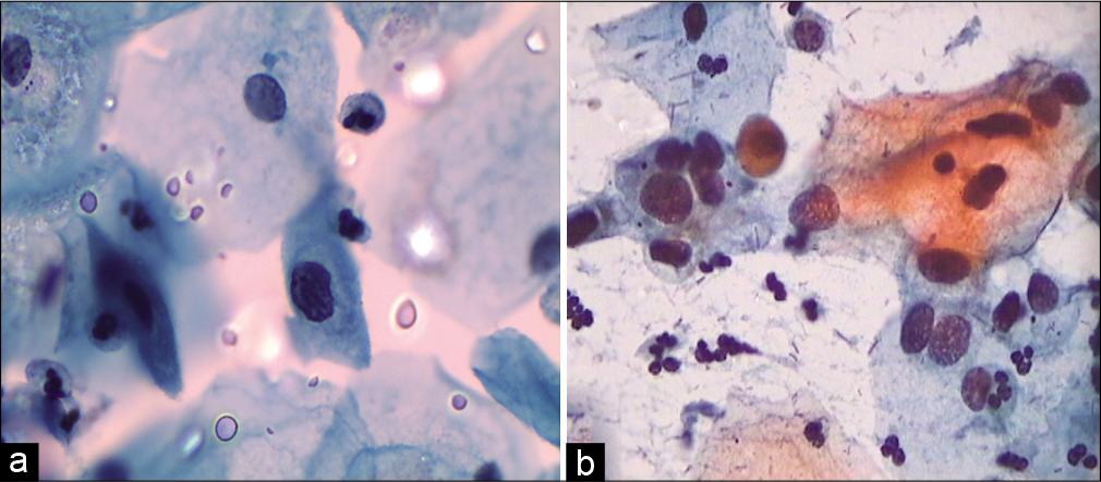 (a and b) SIL, grade cannot be determined. Cells of LSIL and few suggestive of HSIL are seen. Instead of overcalling of CIN grade, one can give an interpretation of ASC-H in addition to LSIL interpretation.