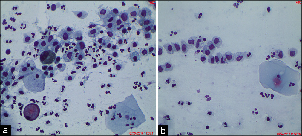 (a and b) Histiocytes can be confused and labeled as ASC/ASC-H.