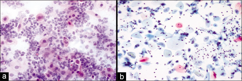 (a) Conventional Pap smear and (b) liquid-based cytology (LBC) preparation showing acute radiation changes: Superficial and intermediate cells along with inflammation, necrotic debris in the background (×10). LBC smear shows a cleaner background.